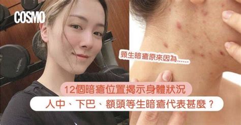 暗瘡位置|13個暗瘡位置反映什麽健康狀態？中醫療法 